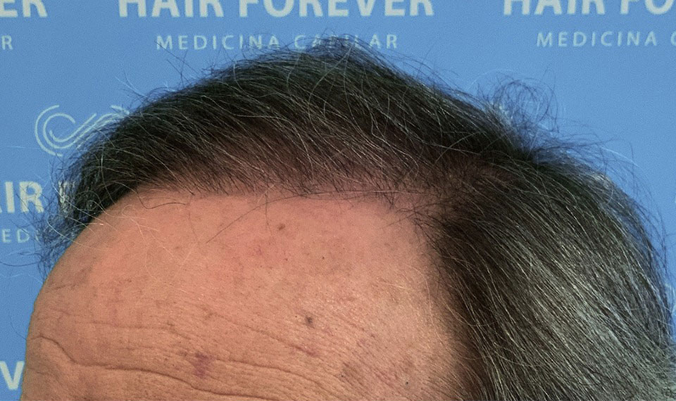 despues-hair-forever